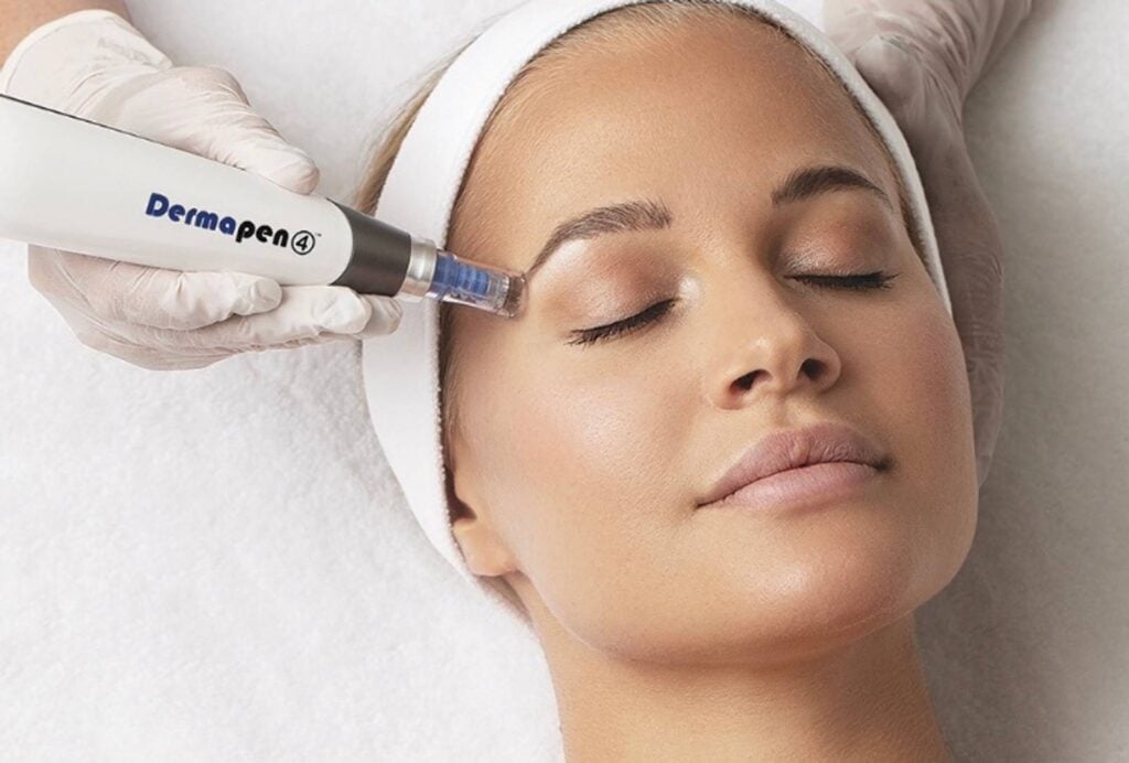 How Microneedling Works for Melasma