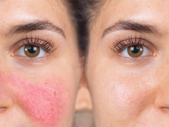 Less Common Risks of Microneedling with Exosomes