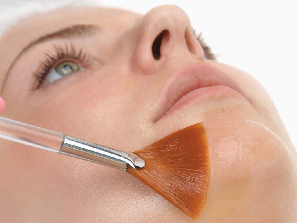 How Chemical Peels Work for Acne Scars and Pigmentation