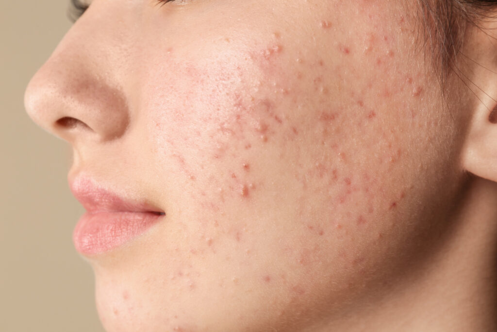 Understanding Acne and Acne Scars