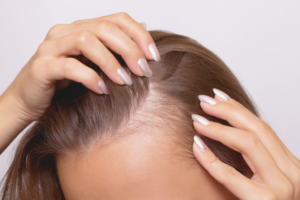 What are the side effects of microneedling for hair growth?