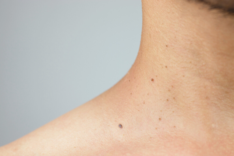 Electrolysis for Skin Tag Removal: A Quick and Gentle Solution for Smooth, Clear Skin