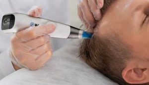 Scalp Microneedling for Hair Loss — a therapist performing Exo-Grow Scalp Microneedling on a client