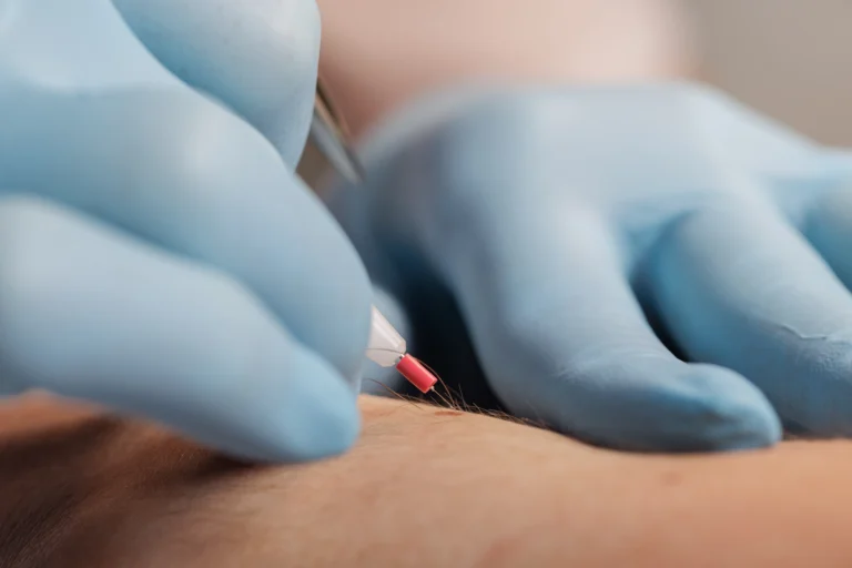 Electrolysis — professional aesthetician performing electrolysis hair removal on client
